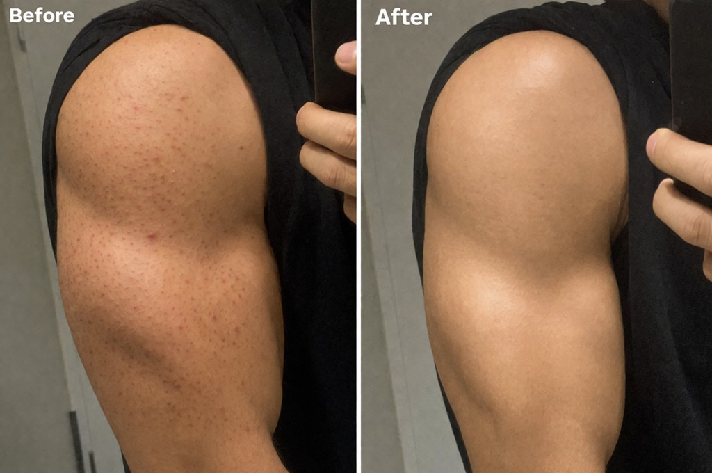 Anti-Pickel Face & Body Scrub